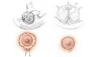 乳暈再造術(shù)價(jià)格是多少？