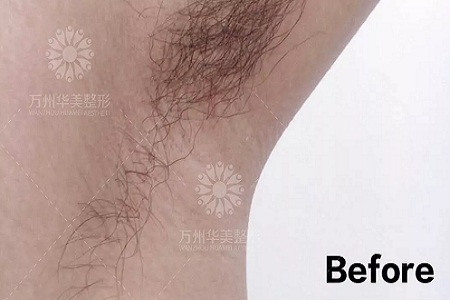萬(wàn)人脫毛節(jié)丨脫毛到底要幾次才能脫干凈呢？