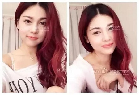 為什么打了玻尿酸，還要我再打玻尿酸？