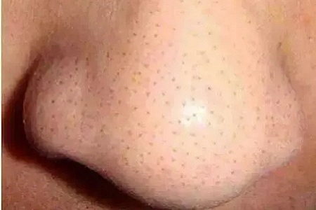 你知道臉上的黑頭和白頭是怎么形成的嗎？