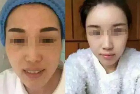 自體脂肪活顏精*，讓你年輕20歲