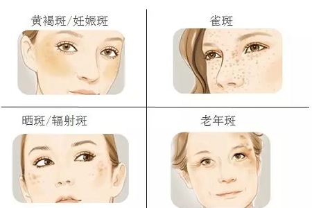 祛斑偏方“害死人”，小仙女們可長點心吧！