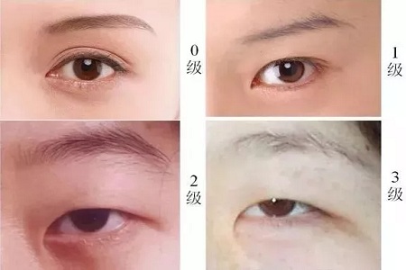 推薦這幾種增大眼睛的方法，除了開外眼角！