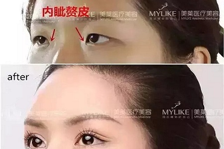 推薦這幾種增大眼睛的方法，除了開外眼角！