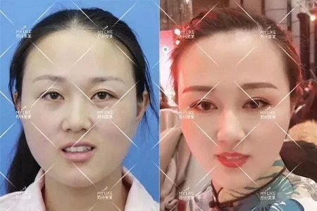 推薦這幾種增大眼睛的方法，除了開外眼角！