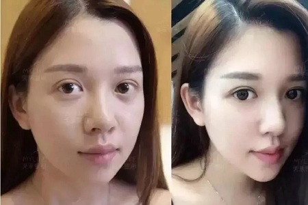 推薦這幾種增大眼睛的方法，除了開外眼角！