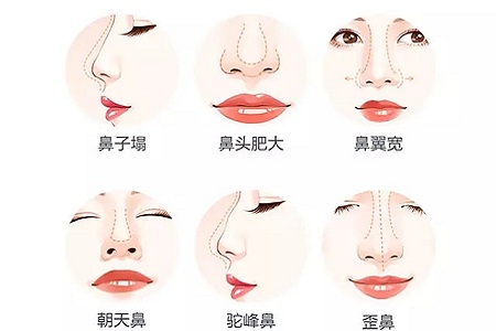 什么，隆鼻方式竟然有這么多種？