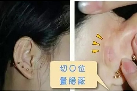 什么，隆鼻方式竟然有這么多種？