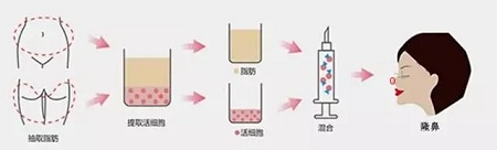 什么，隆鼻方式竟然有這么多種？