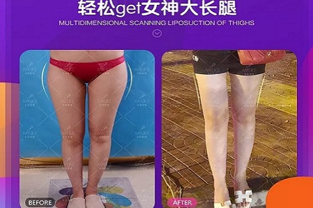 醫美白皮書：吸脂等于減肥嗎？