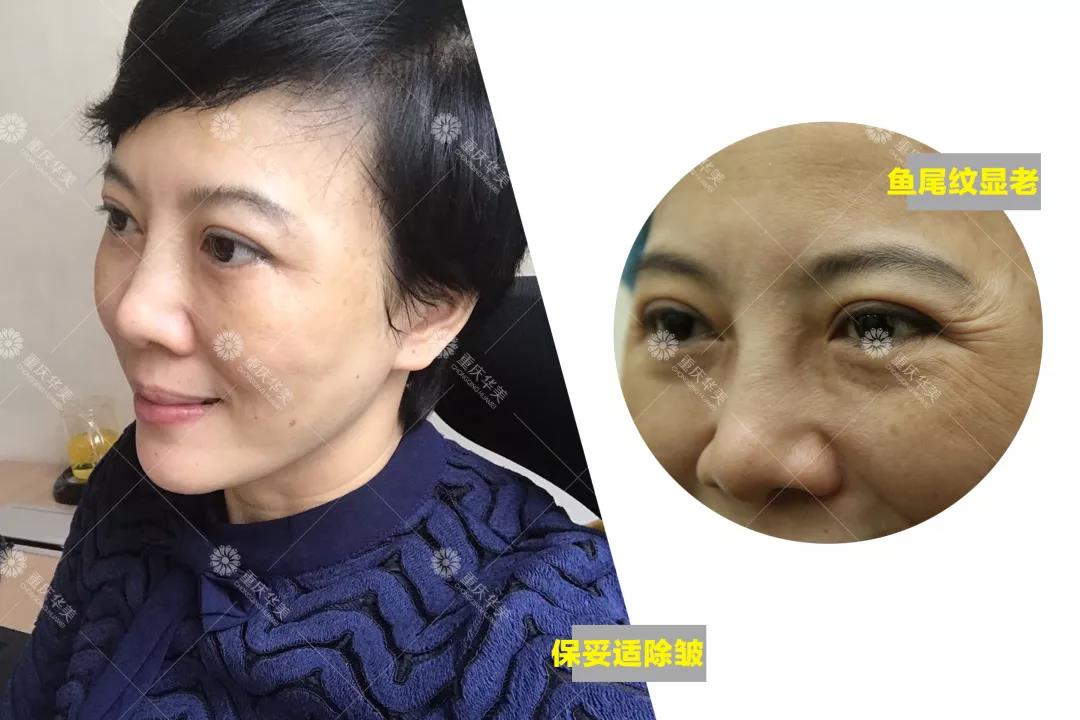 如果你是這種臉型，打瘦臉針一定有用！