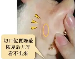 糾結(jié)！鼻頭太圓想塑形是用肋軟骨還是耳軟骨好？