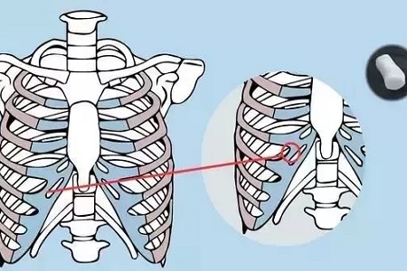 糾結(jié)！鼻頭太圓想塑形是用肋軟骨還是耳軟骨好？