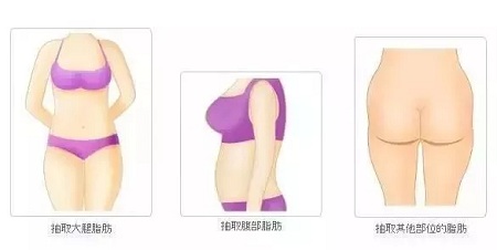 讓明星“一夜回春”的自體脂肪到底適不適合你？