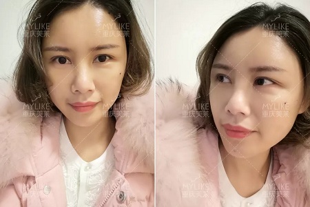 讓明星“一夜回春”的自體脂肪到底適不適合你？