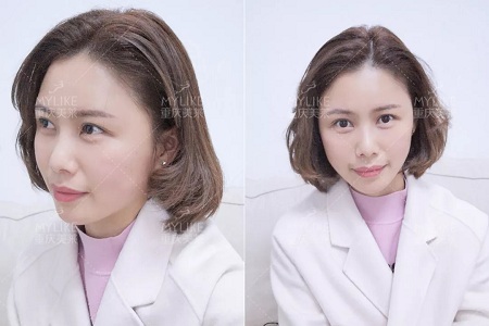 讓明星“一夜回春”的自體脂肪到底適不適合你？