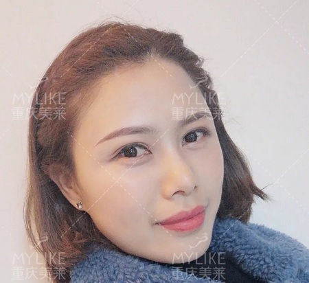 讓明星“一夜回春”的自體脂肪到底適不適合你？