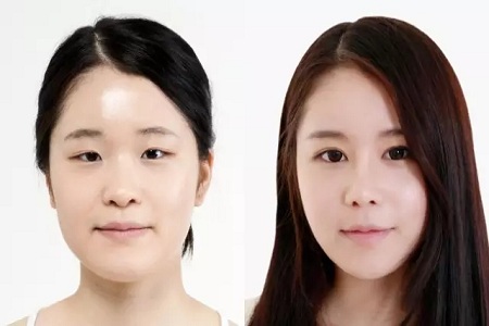 雙眼皮+開眼角為什么是較佳拍檔，一分鐘帶你看懂！