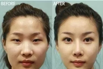 雙眼皮+開眼角為什么是較佳拍檔，一分鐘帶你看懂！