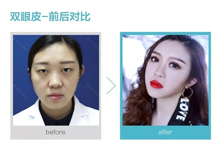 做了雙眼皮，醫(yī)師為什么建議要多睜眼？