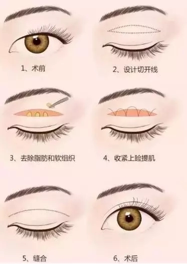 問(wèn)診室：做雙眼皮前，這些問(wèn)題你需要提前了解！