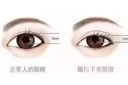 問(wèn)診室：做雙眼皮前，這些問(wèn)題你需要提前了解！