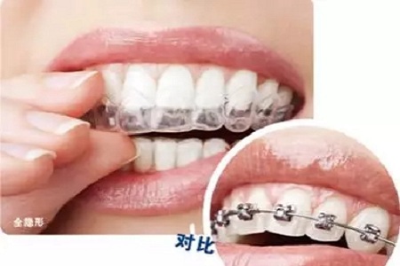 新品：整牙=換臉？隱適美IGO實現所有不可能！
