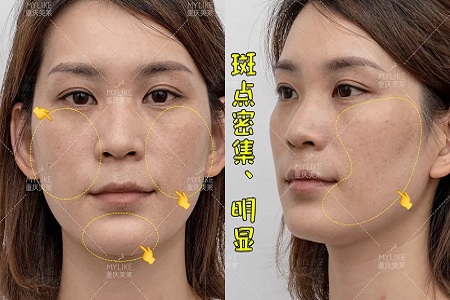 那個斑點女孩后來怎么樣了？