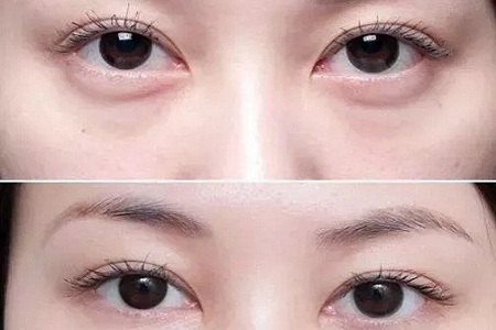 每到放假，做這個項目的人就會增多！--眼袋