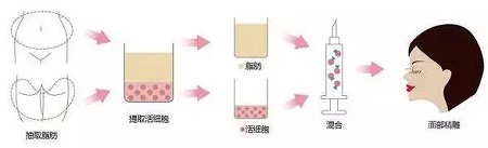 明星的臉和你的臉差的只是這一步！--面部脂肪填充