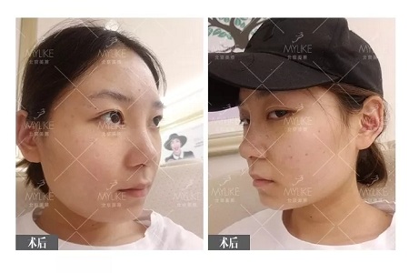 顏值：插座鼻變小翹鼻，就是這么神奇！