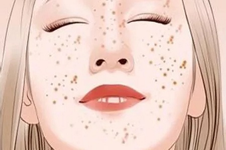 問診室：祛斑不難，找對病因才是重點，祛斑較全面科普看過來
