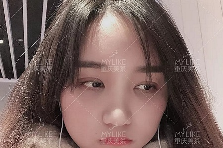 自體脂肪+雙眼皮，這對cp你不pick一下嗎？
