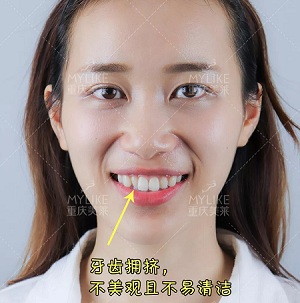 這種牙齒矯正方式，96%的人都會(huì)選擇！