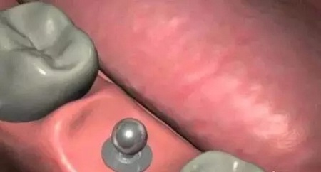 揭秘牙齒矯正的全過程！！！