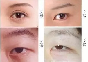 美萊實驗室：開眼角就是醫(yī)師想多收錢？