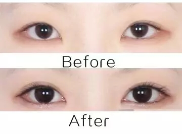 美萊實驗室：開眼角就是醫(yī)師想多收錢？