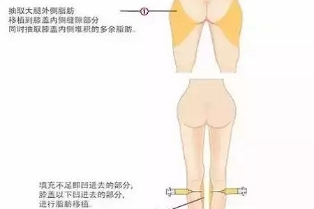 問診室：你說(shuō)脂肪壓得你好累，殊不知它也可以是寶貝