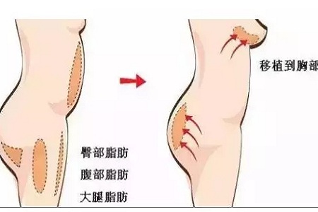 問診室：你說(shuō)脂肪壓得你好累，殊不知它也可以是寶貝