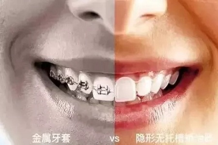 告別鋼牙妹——隱形矯正新時代，拯救尷尬的微笑！