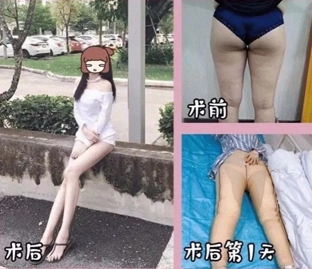吸脂手術