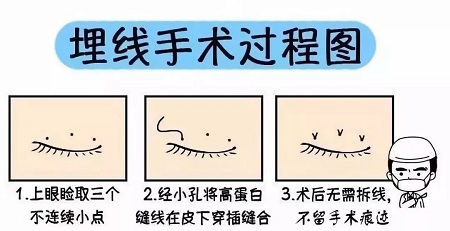 美眼張誠坐診美萊，淺談為什么你的眼睛不夠美？