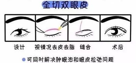 美眼張誠坐診美萊，淺談為什么你的眼睛不夠美？