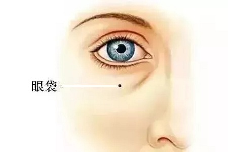 眼袋也分很多類型，看看你屬于哪一型？