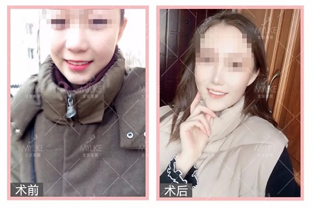 顏值日志 | 鼻子對整體顏值的改變有多大？