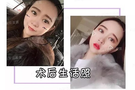 割雙眼皮
