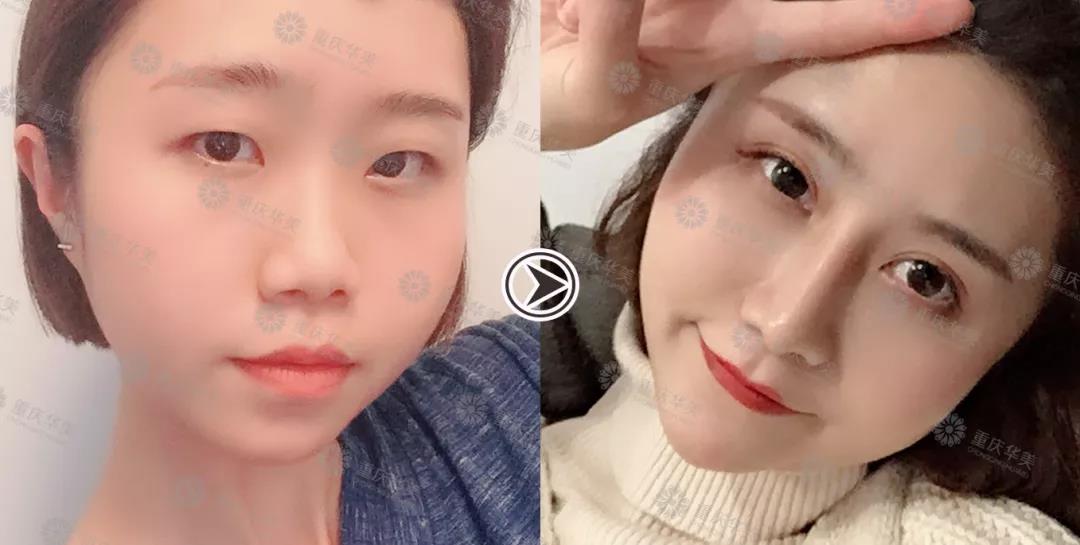 雙眼皮手術前后對比