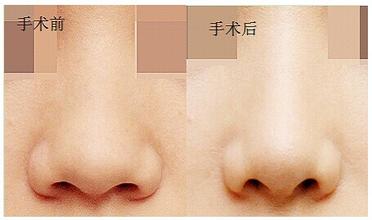 鼻尖整形要多少錢(qián)