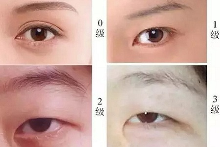 內眥贅皮分類