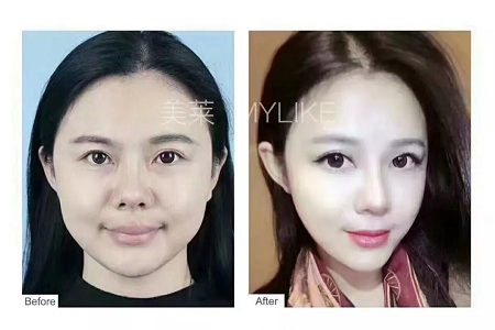 想抗衰，*雕和玻尿酸哪個更適合？